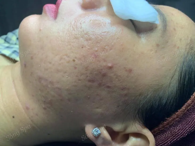 Kết quả nặn mụn tại Sóng Spa Quận 9 – buổi đầu