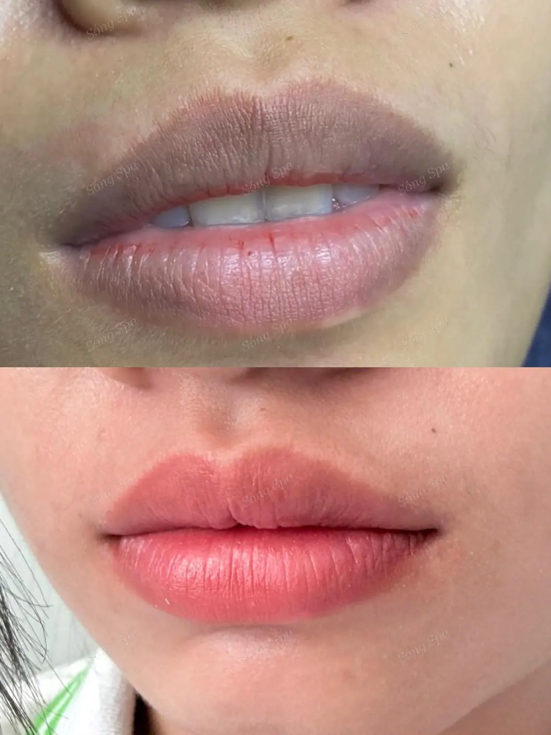 Khử thâm môi lên màu tự nhiên tại Thủ Đức